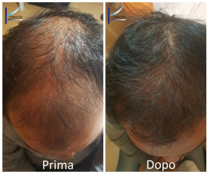  Alopecia Androgenetica prima e dopo 4 mesi di trattamento