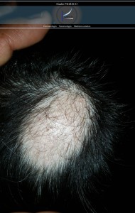 Una forma di alopecia areata.